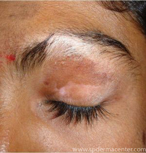 Vitiligo-eye-repigmentation